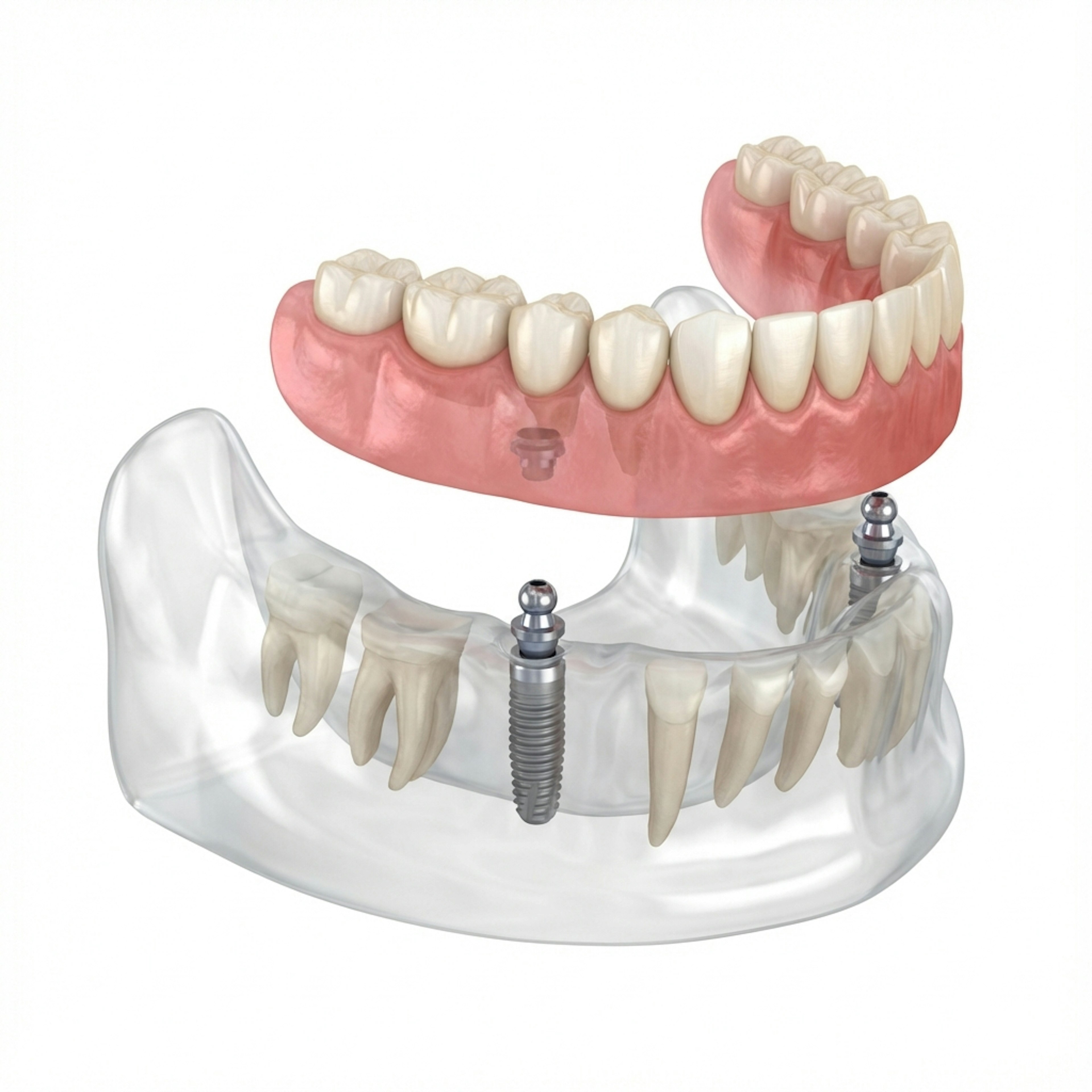 Implant Supported Denture Diagram